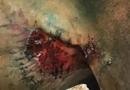 Рваная рана коленной складки и паха, Через 14 дней